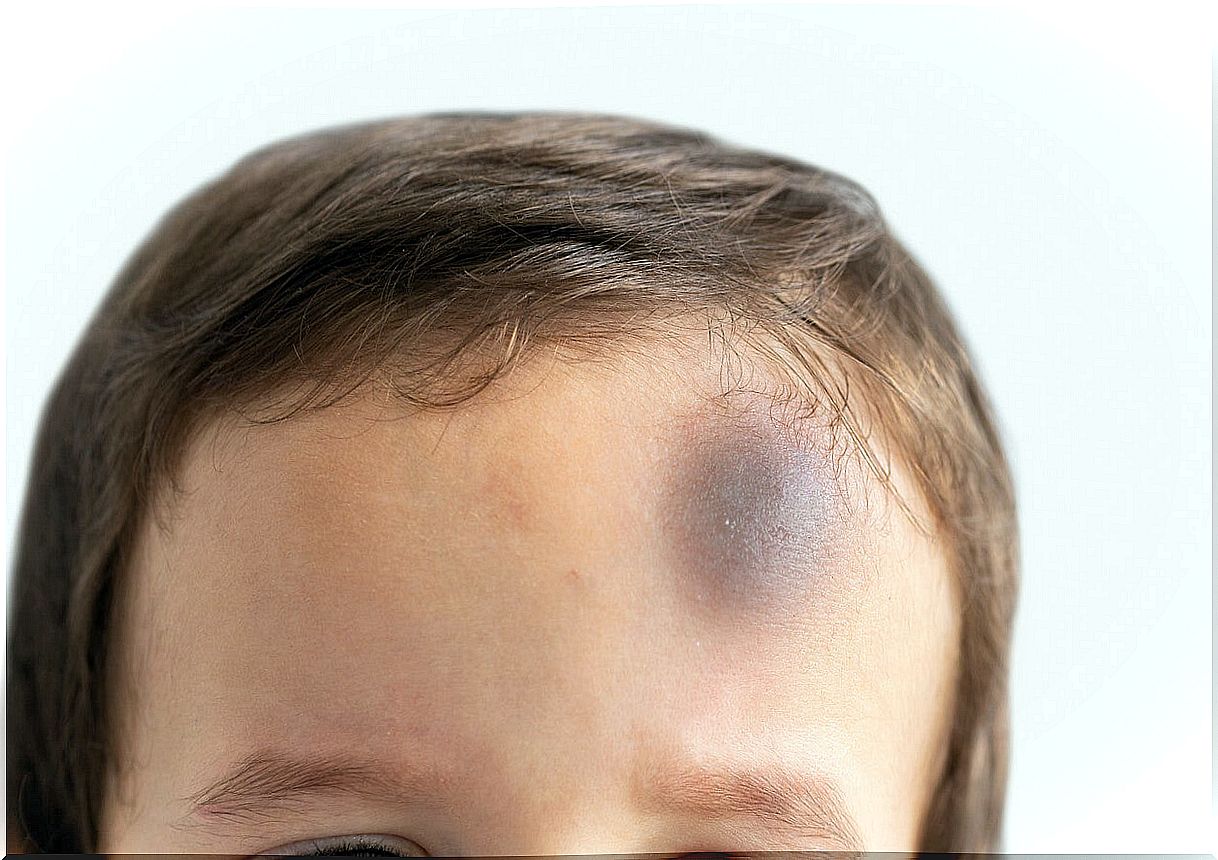 Boy with a very large bump on his forehead.