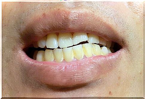 Appearance of stains on permanent teeth