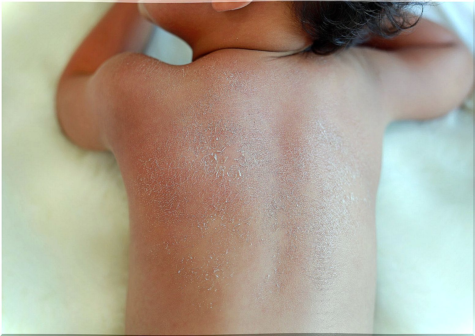 Dry skin in children