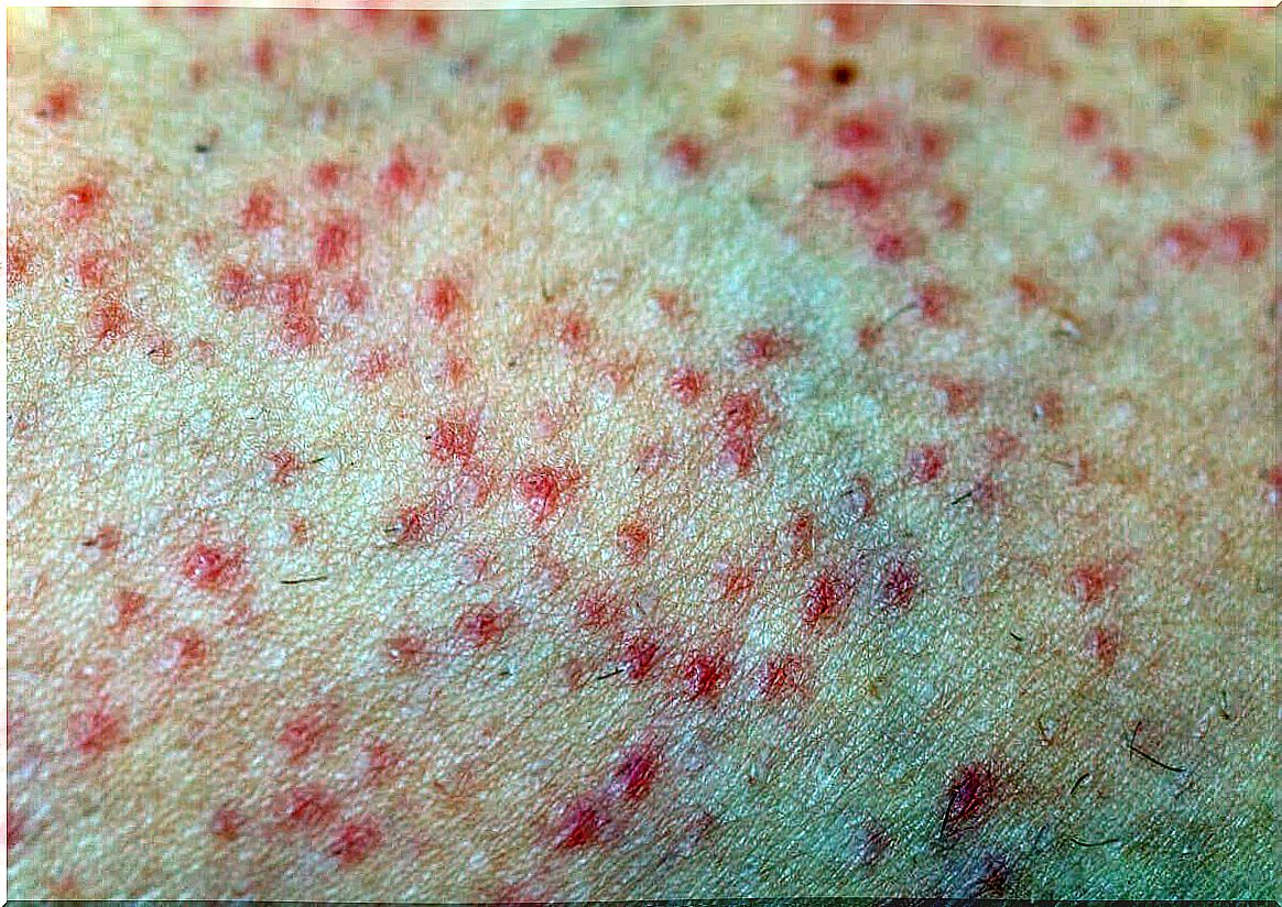 Keratosis pilaris