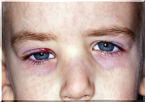 Styes in children are very annoying.