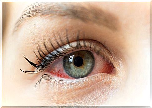 How to prevent the spread of conjunctivitis to children