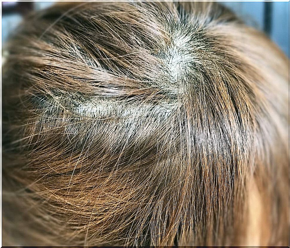 Head of a boy with bald spots due to pulling out strands of hair due to trichotillomania.