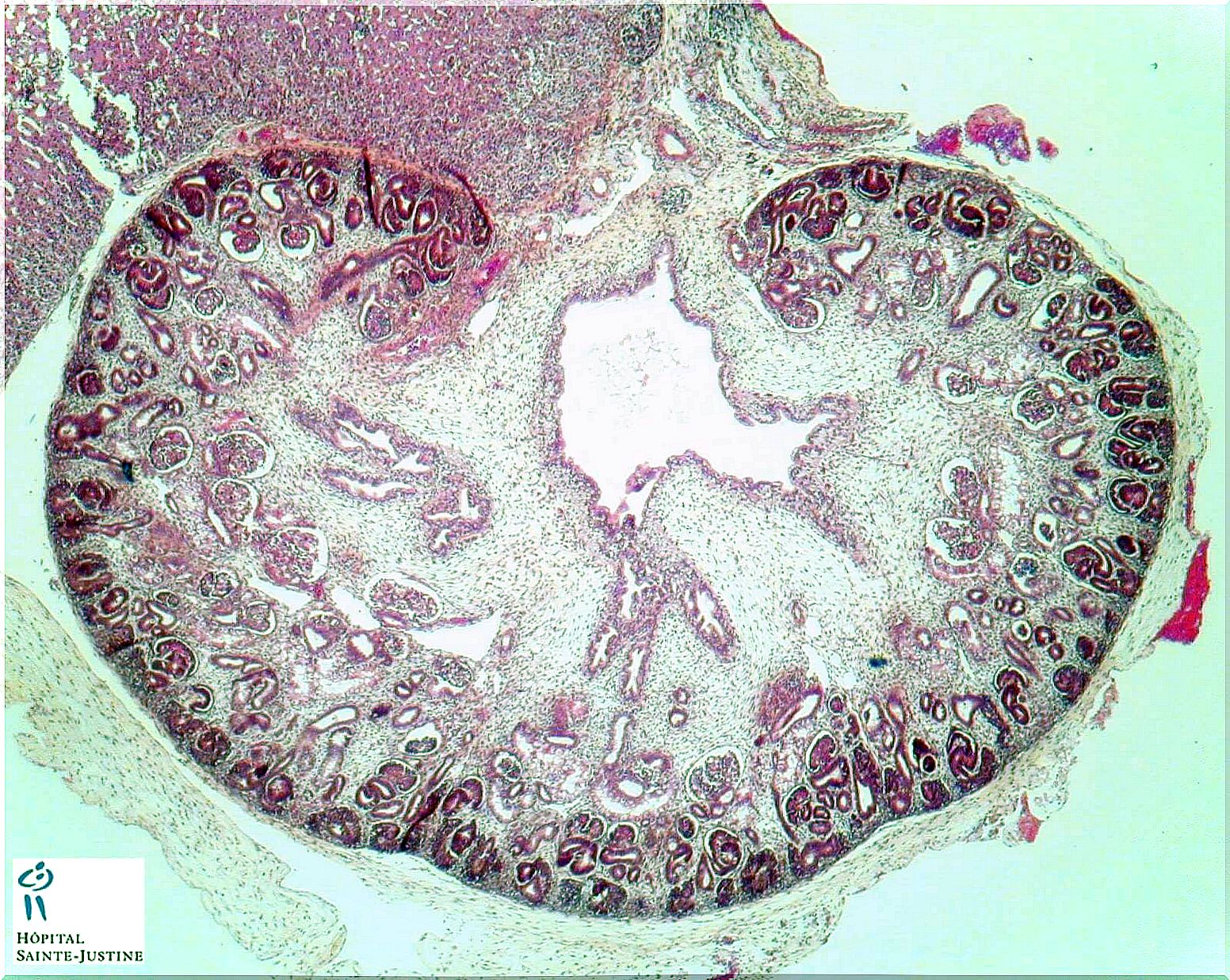 What is fetal pyelic ectasia?